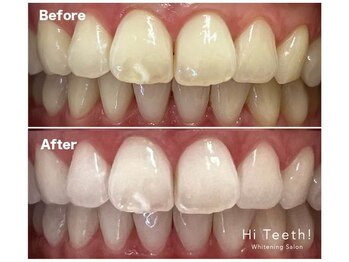 ハイティース 高田馬場店(Hi Teeth!)/医療提携セルフホワイトニング