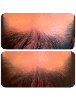 ピエリ ザ ビューティステイション 春日原店(Pierie THE BEAUTY STATION)/ヒト幹細胞スパ