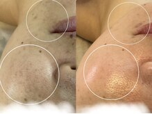 アンベリール(Embellir)/REVIピーリング/1回目→3回目