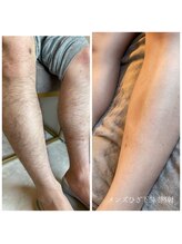 エクラ(eclat)/メンズひざ下脱毛