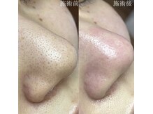 リッカロッカ(RIKKA&ROCCA)の雰囲気（毛穴洗浄で肌が変わる！毛穴の詰まり・黒ずみもつるんッ）