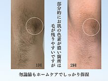 アンジェリーナ/メンズ脱毛/フラッシュ脱毛　