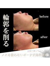 クリニカルボーテ 心斎橋院(CLINICAL BEAUTE)/本気小顔になりたいなら毎月ケア