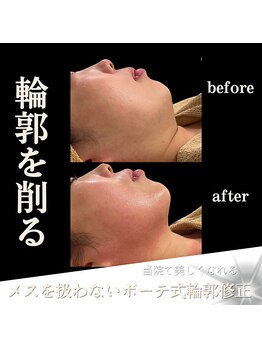 クリニカルボーテ 心斎橋院(CLINICAL BEAUTE)/本気小顔になりたいなら毎月ケア