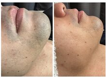 エステサロン オパール(OPALE)の雰囲気（男性も綺麗の常識！固く頑固な髭に奥まで照射でつるすべ肌）