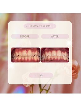 プラスビー 2号店(+b)/ホワイトニングビフォーアフター