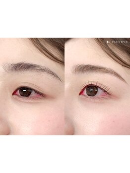 顔脱毛がしたい