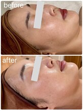 月とルーツ 大阪南堀江(月とroots)/エイジングケア.毛穴.ハリ弾力