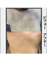 ココ 梅田中津(COCO.)/背中＊ハーブピーリング