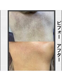 ココ 梅田中津(COCO.)/背中＊ハーブピーリング