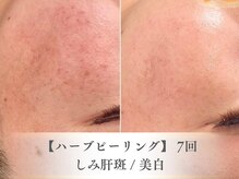 ベルペール(Belle perle)/【ハーブピーリング】毛穴/シミ