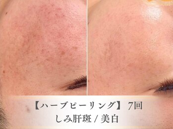 ベルペール(Belle perle)/【ハーブピーリング】毛穴/シミ