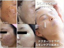 リリィ/ドクターリセラで肌悩み改善へ