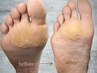 【FOOT】足裏の角質除去／魚の目除去　+　マッサージ　 ¥6000