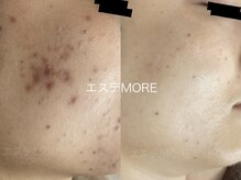 リラクゼーションエステ モア(MORE)の雰囲気（敏感肌～慢性ニキビ、シミ毛穴など、肌悩み全てに対応してます）