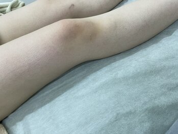 ナノハナ/鹿沼市全身脱毛美容室ナノハナ