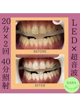 ココティ ホワイトニング(Cocotii)/ビフォーアフター