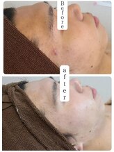 サロンド シェリー(Salon de Cherie)/男性　剥けないハーブピーリング