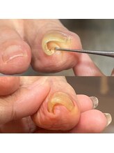 ウェルズユキ(well's yuki)/巻き爪／変形爪／肥厚爪