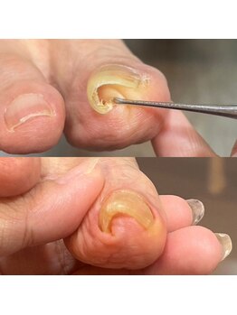 ウェルズユキ(well's yuki)/巻き爪/変形爪/肥厚爪