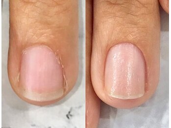 リファーレ(RIFARE)/【深爪矯正】ビフォーアフター♪