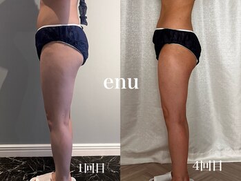 エヌ 白金台(enu)/セル脂肪に徹底アプローチ