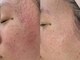 アオラ(Aola)の写真/-肌悩みに終止符を-「あ、違う…!」と施術後の変化に感動！細胞レベルから肌質改善し、自信あふれる素肌へ