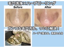脱毛マックス 南越谷店(MAX)の雰囲気（お肌の悩みに合わせてメニュー相談ok！1番人気は毛穴×ハーブ！）