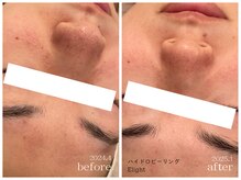 メゾンリュバン 梅田店(Maison Ruban)/毛穴洗浄・美白フォト|毛穴ケア