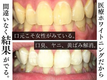 ジェントルメンズグロー(Gentlemen’s Glow)/【セルフホワイトニング】