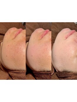 ホウレイ線・たるみ改善！予防ケア