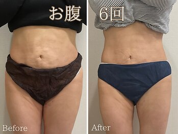 シエナ(ciena)/マグフォース(痩身)♪