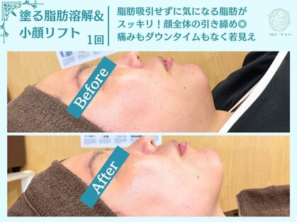 フローフシ∞の写真