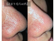 ル シーニュ/詰まり・黒ずみ毛穴40代