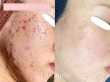 リラベル(Lira Belle)/TIP集中改善プログラム