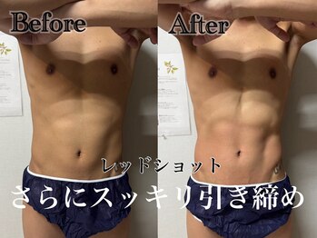 アンドエス 六本木(and S.)/韓国発最新美容レッドショット