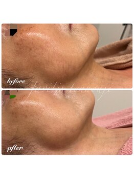 ファビリス 天王寺店(FAVILIS)/ACトリートメント+MSSF/50代