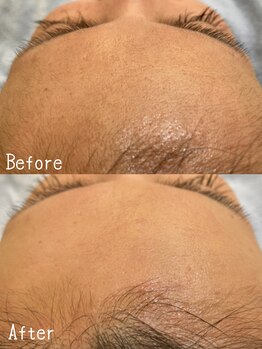 クレアトゥール/フェイシャルスキンケアWAX脱毛