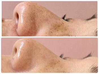 ポモナ 横浜馬車道店(Pomona)/シミケア/シミ改善 毛穴も改善◎