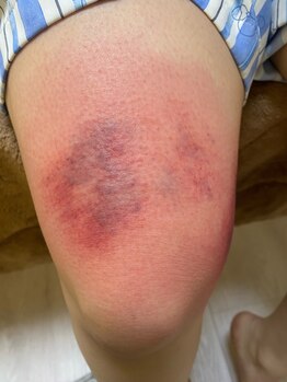 コル コルエ(koru korue)/膝の不具合はこれが原因かも