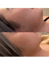 ナースセレクトサロン(Nurse select salon)/タイトニングリフト
