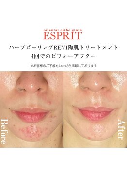 エスプリ 新宿店/ハーブピーリングREVI陶肌