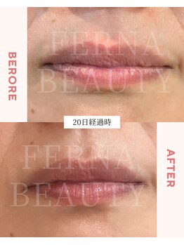 フェルナ(FERNA)/ローマピンク