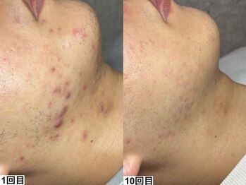 アンドミー 横浜(&me)/繰り返す肌荒れ対策に＊