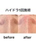 【毛穴悩み無しに！】水素で毛穴洗浄♪通常￥4000→Open破格価格お試し￥500