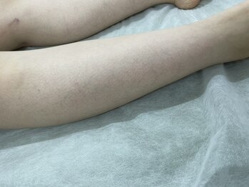 ナノハナ/鹿沼市全身脱毛美容室ナノハナ