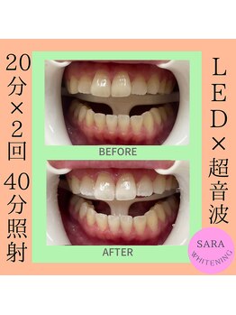 ココティ ホワイトニング(Cocotii)/ビフォーアフター