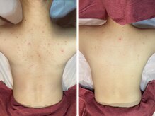 リアンジェ(Lianje)/背中ハーブピーリング