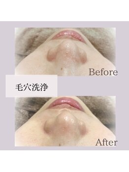 メロウ(Mello)/毛穴洗浄◇Before→after