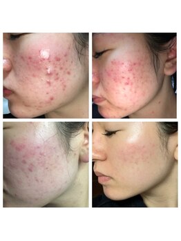 ビーシェイプ 君津(B-Shape)/症例【ハーブピーリング】